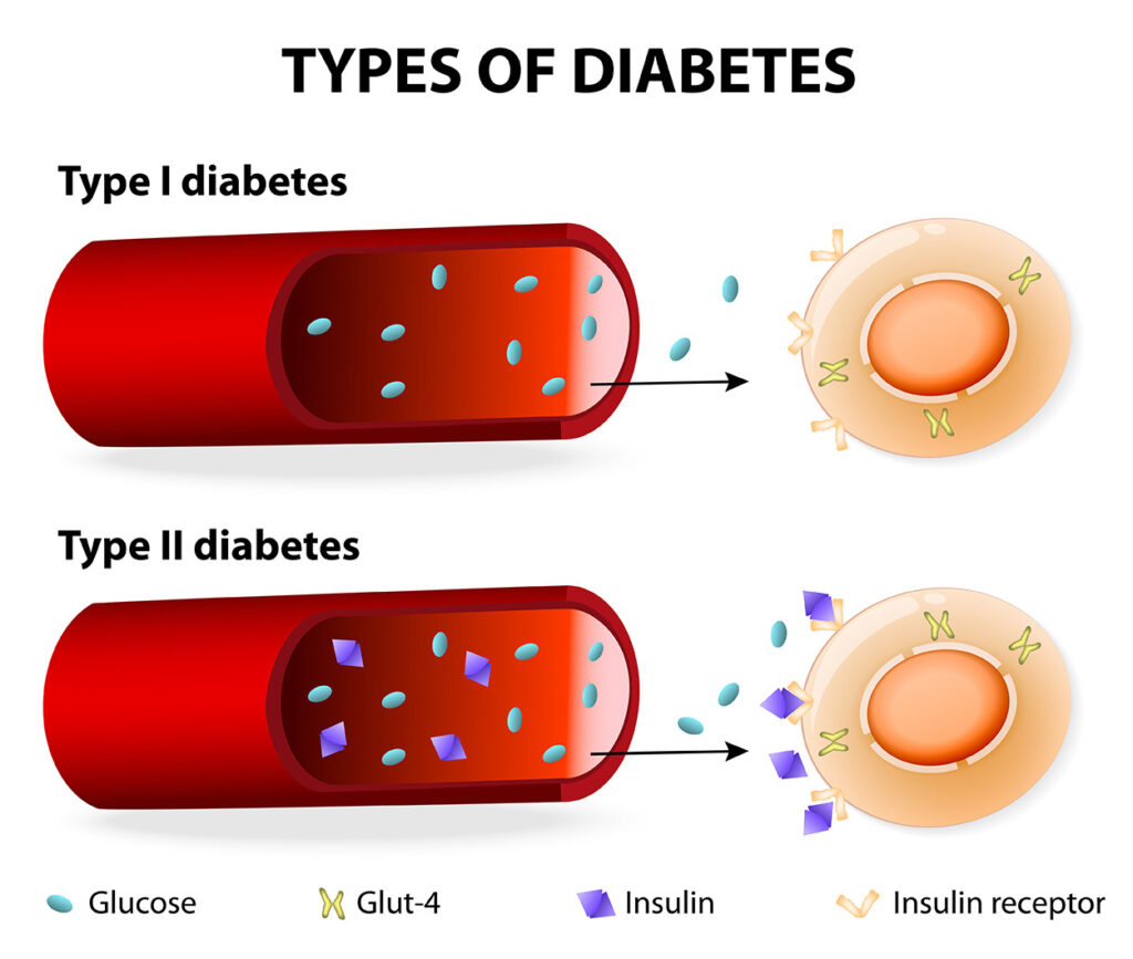 types of diabetes 11 3 ancient diabetes reversal