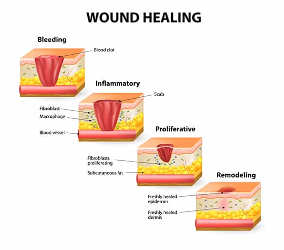 wound healing ancient diabetes reversal