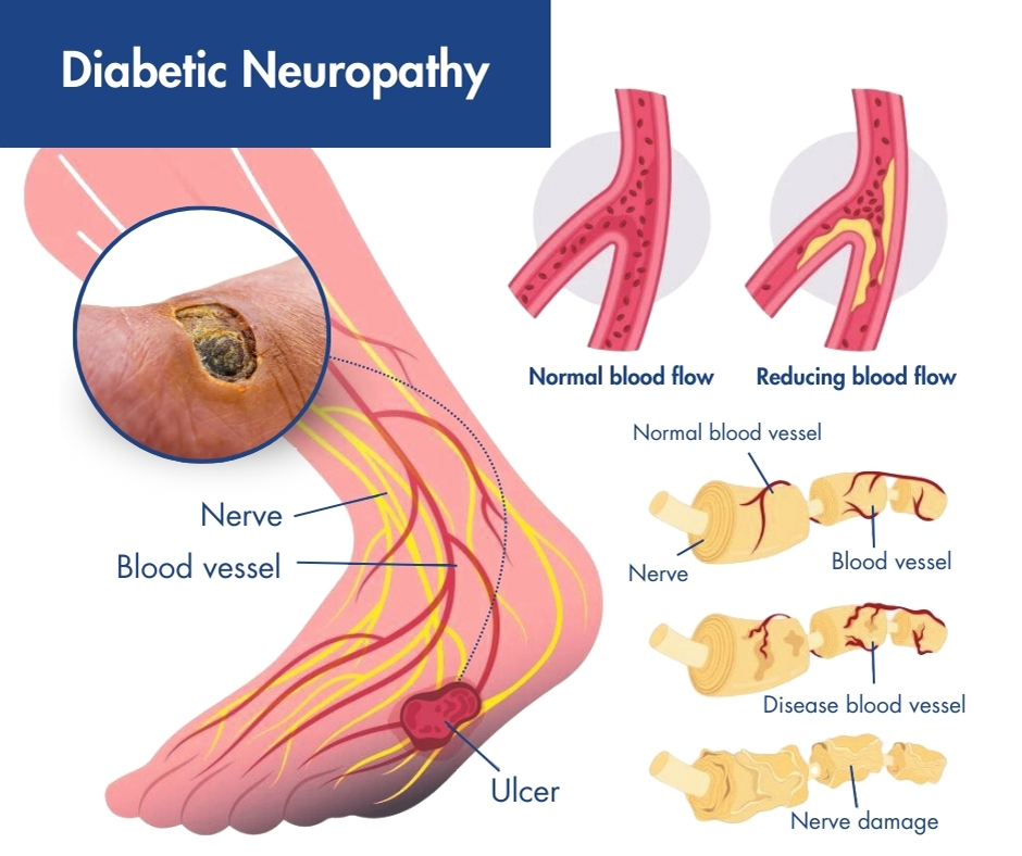 How daily 2 Mushrooms Are Transforming Nerve Health: Groundbreaking Research from Johns Hopkins and California University 1 diabetic neuropathy info ancient diabetes reversal